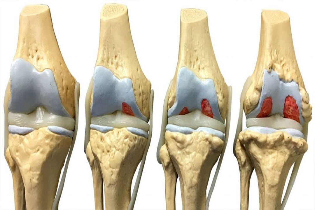 stages of development of osteoarthritis