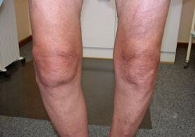 How to treat osteoarthritis on the knee joint