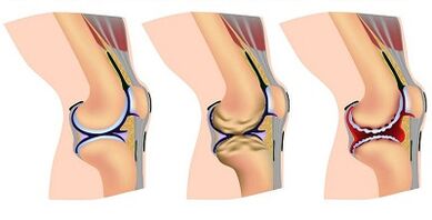 Stages of development of osteoarthritis of the knee joint
