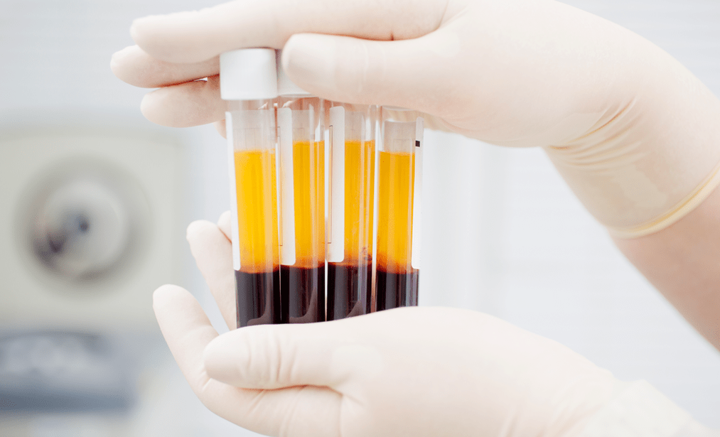 Platelet Rich Plasma for PRP Treatment of Osteoarthritis