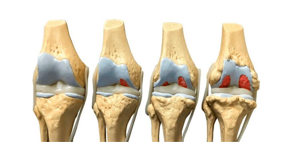 degree of osteoarthritis of the joints